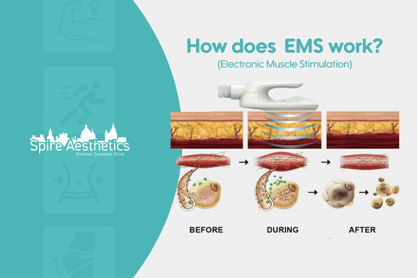 EMS treatment for post pregnancy weight loss treatment Headingley