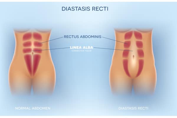 What Non-Surgical Options Are Available for Diastasis Recti Headingley?