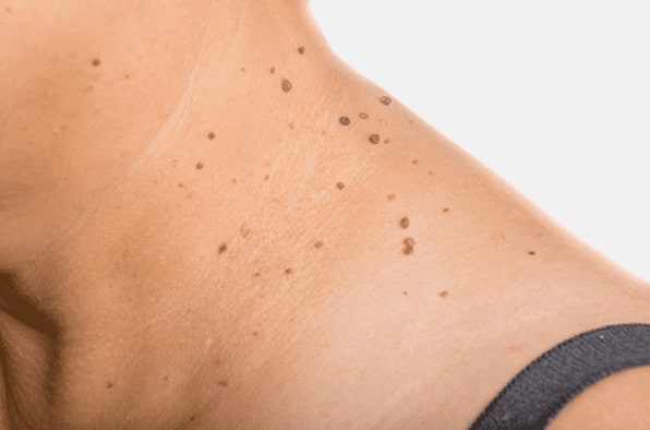 Are you looking for easy skin tag removal Headingley - then contact Spire today!