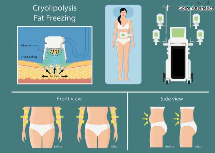 Image of diet and fat freezing combined for best results for Spire Aesthetics Headingley
