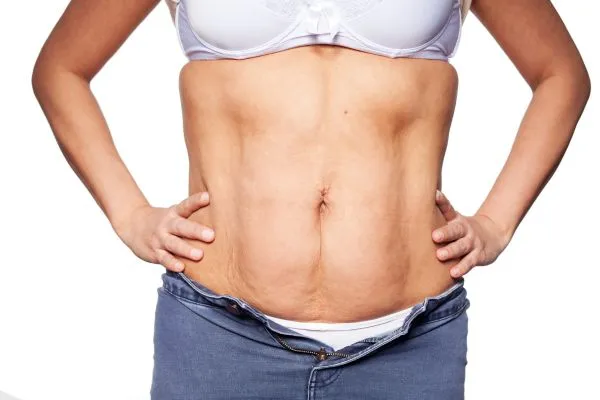 sagging skin on woman's stomach after weight loss injections Headingley
