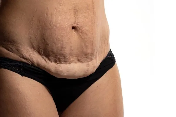 Image of womans stomach after weight loss injections Headingley showing saggy skin