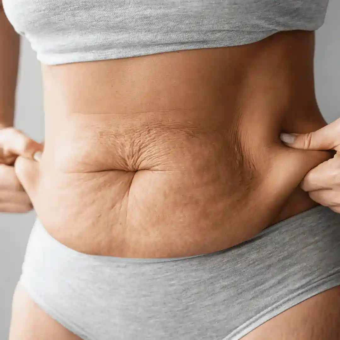 Is It Normal to Have Loose Skin After Pregnancy Headingley?